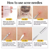 Acne Needle Blackhead Clip Remover
