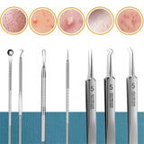 Acne Needle Blackhead Clip Remover